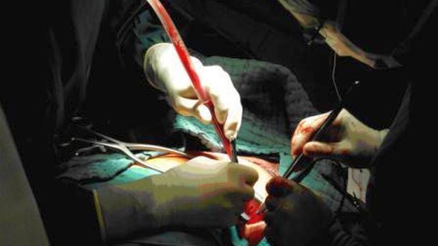 Institut "Dedinje" po prvi put implantirao vensku elektrodu za stimulaciju srčane komore